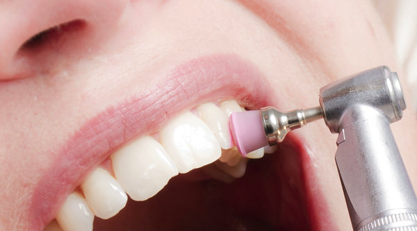 ¿Limpieza dental, qué es y para qué sirve?