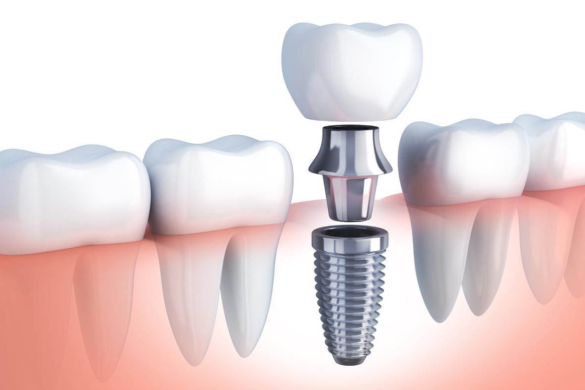 Implante dental colocado entre dientes naturales