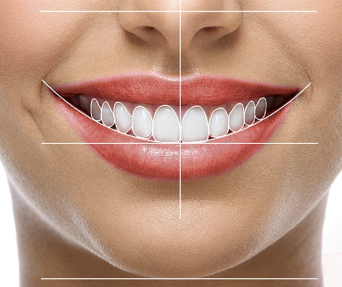 Sonrisa blanca y alineada tras diseño de sonrisa